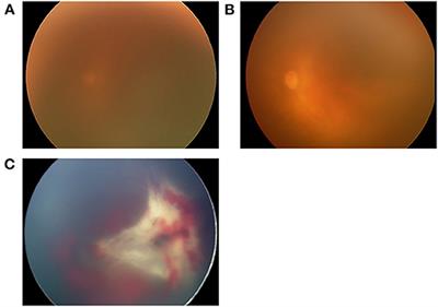 Characteristics of Eyes Developing Retinal Detachment After Anti-vascular Endothelial Growth Factor Therapy for Retinopathy of Prematurity